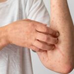 OPS alerta por repunte de sarampión