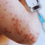 Centroamérica refuerza vacunación ante brote de sarampión