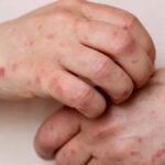 El Salvador confirma once casos importados de sarampión