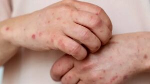 El Salvador sarampión