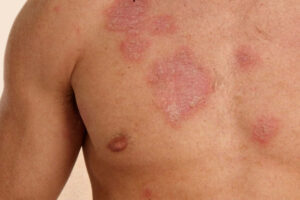 Lupus en El Salvador