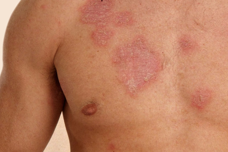 Lupus en El Salvador